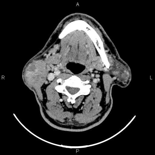 Bilateral Warthin tumors (Radiopaedia 84034-99263 Axial With contrast 33).jpg