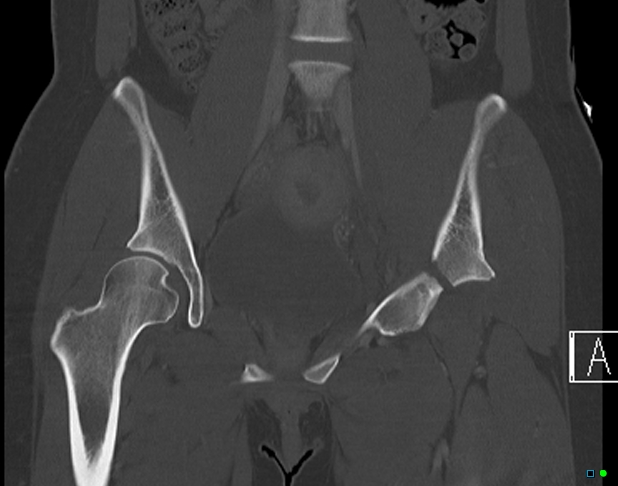 File:Bilateral acetabular fractures (Radiopaedia 79272-92308 Coronal bone window 16).jpg