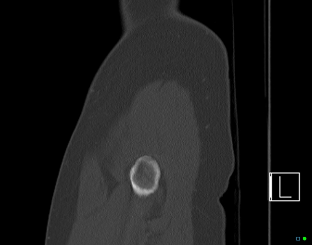 Bilateral acetabular fractures (Radiopaedia 79272-92308 Sagittal bone window 2).jpg