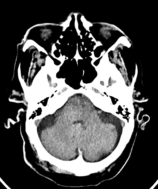 Bilateral acute on chronic subdural hematomas (Radiopaedia 78466-91146 Axial non-contrast 17).jpg
