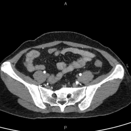 Bilateral adrenal gland hyperenhancement in pancreatitis (Radiopaedia 86642-102753 B 101).jpg