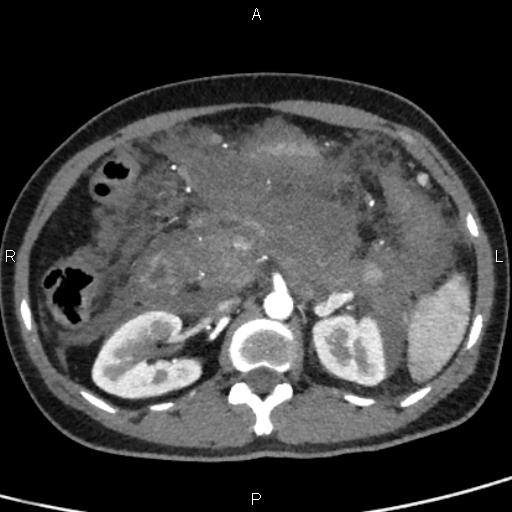 Bilateral adrenal gland hyperenhancement in pancreatitis (Radiopaedia 86642-102753 B 53).jpg