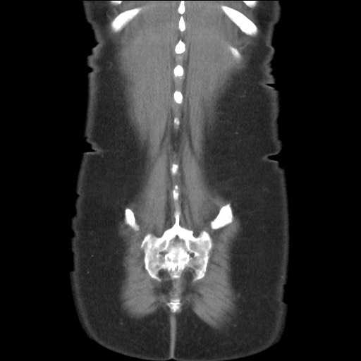 Bilateral adrenal granulocytic sarcomas (chloromas) (Radiopaedia 78375-91007 B 84).jpg
