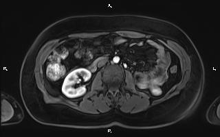 Bilateral adrenal myelolipoma (Radiopaedia 63058-71537 Axial T1 C+ fat sat 56).jpg