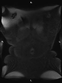 Bilateral adrenal myelolipoma (Radiopaedia 63058-71537 Coronal T1 fat sat 1).jpg