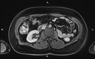 File:Bilateral adrenal myelolipoma (Radiopaedia 63058-71537 H 55).jpg
