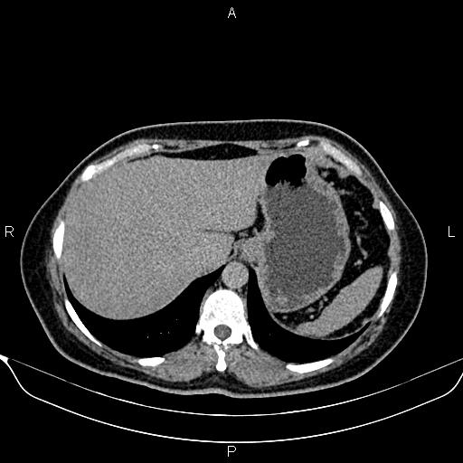 Bilateral benign adrenal adenomas (Radiopaedia 86912-103124 Axial C+ delayed 11).jpg