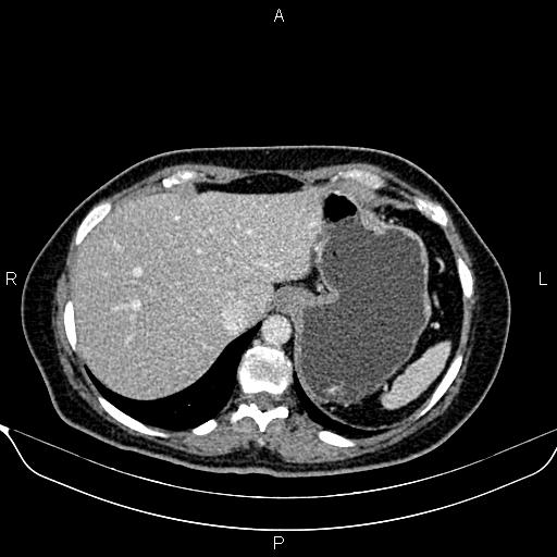 Bilateral benign adrenal adenomas (Radiopaedia 86912-103124 B 22).jpg
