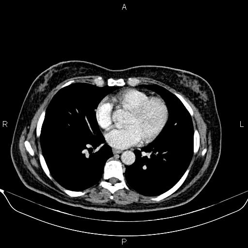 Bilateral benign adrenal adenomas (Radiopaedia 86912-103124 B 3).jpg