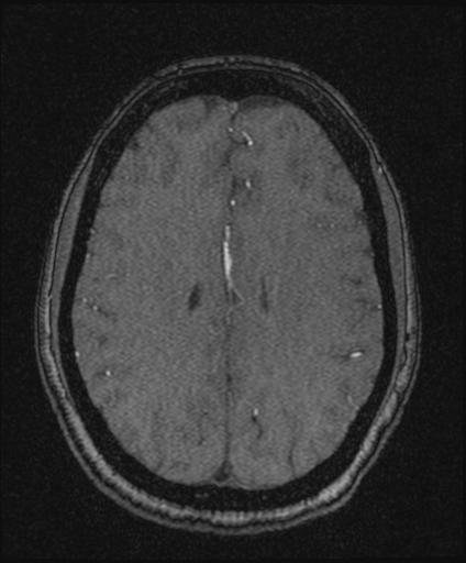 Bilateral carotid body tumors and right glomus jugulare tumor (Radiopaedia 20024-20060 Axial MRA 124).jpg