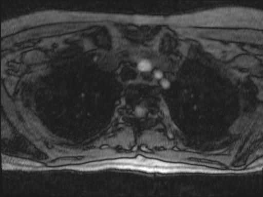 File:Bilateral carotid body tumors and right jugular paraganglioma (Radiopaedia 20024-20060 Axial 279).jpg