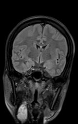File:Bilateral carotid body tumors and right jugular paraganglioma (Radiopaedia 20024-20060 Coronal 57).jpg