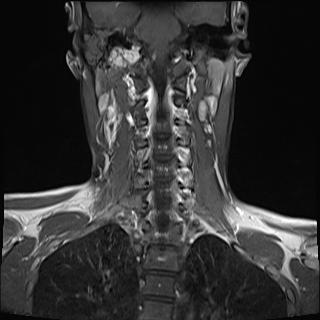 File:Bilateral carotid body tumors and right jugular paraganglioma (Radiopaedia 20024-20060 None 12).jpg
