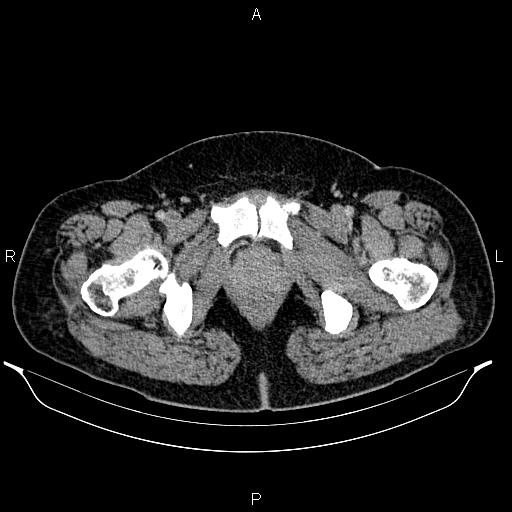 File:Bilateral ovarian dermoid cysts (Radiopaedia 85785-101603 A 110).jpg