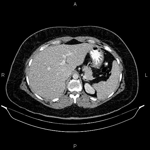 File:Bilateral ovarian dermoid cysts (Radiopaedia 85785-101603 A 28).jpg