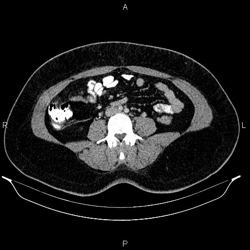 Bilateral ovarian dermoid cysts (Radiopaedia 85785-101603 A 63).jpg