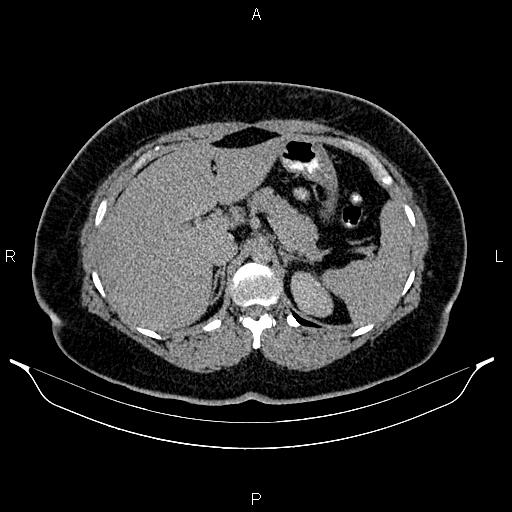 Bilateral ovarian dermoid cysts (Radiopaedia 85785-101603 Axial C+ delayed 15).jpg