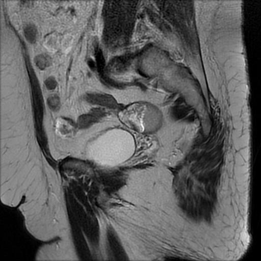 File:Bilateral ovarian dermoid cysts (Radiopaedia 90152-107338 Sagittal T2 8).jpg