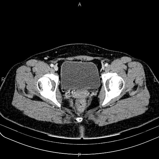 Bilateral ovarian teratoma (Radiopaedia 83131-97503 Axial With contrast 65).jpg