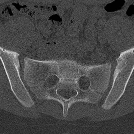 File:Bilateral pars defect (Radiopaedia 26691-26846 Axial bone window 92).jpg