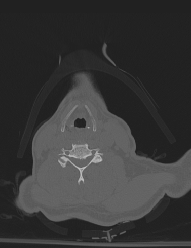 File:Bilateral perched facet joint (Radiopaedia 63149-71669 Axial bone window 37).jpg