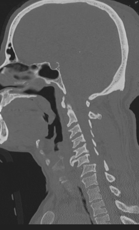 Bilateral perched facet joint (Radiopaedia 63149-71669 Sagittal bone window 23).jpg