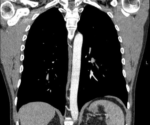 Bilateral pulmonary AVM (Radiopaedia 83134-97505 C 49).jpg