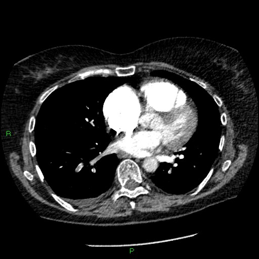 Bilateral pulmonary emboli (Radiopaedia 32700-33669 Axial C+ CTPA 66).jpg