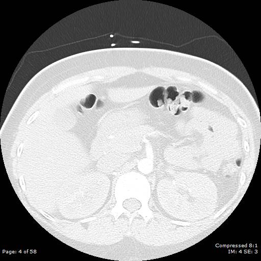 Bilateral pulmonary emboli with Hampton hump sign (Radiopaedia 54070-60246 Axial lung window 4).jpg
