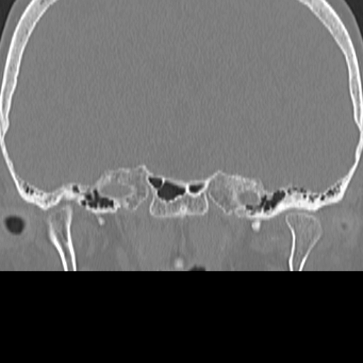 File:Bilateral tympanoplasty (Radiopaedia 16947-16664 Coronal bone window 3).jpg