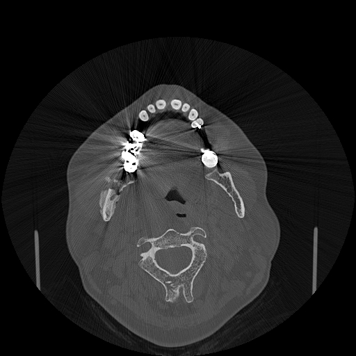 File:Bisphosphonate-related osteonecrosis of the jaw (Radiopaedia 71324-81642 Axial bone window 81).jpg