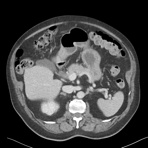 File:Bladder papillary urothelial carcinoma (Radiopaedia 48119-52951 Axial 15).png