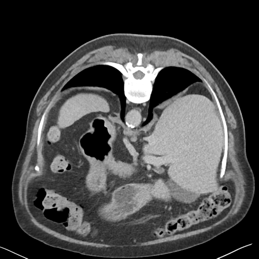 File:Bladder papillary urothelial carcinoma (Radiopaedia 48119-52951 Axial C+ delayed 5).png
