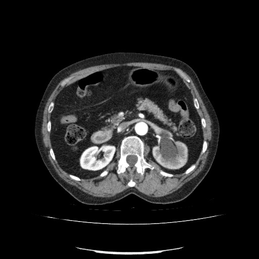 File:Bladder tumor detected on trauma CT (Radiopaedia 51809-57609 A 100).jpg