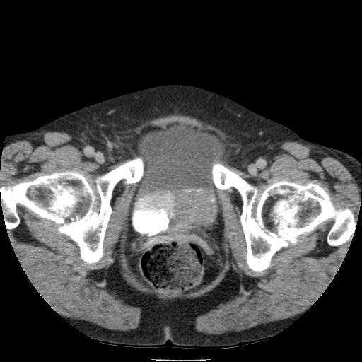 Bladder tumor detected on trauma CT (Radiopaedia 51809-57609 C 136).jpg