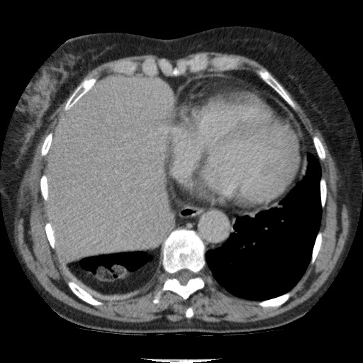 Bladder tumor detected on trauma CT (Radiopaedia 51809-57609 C 14).jpg