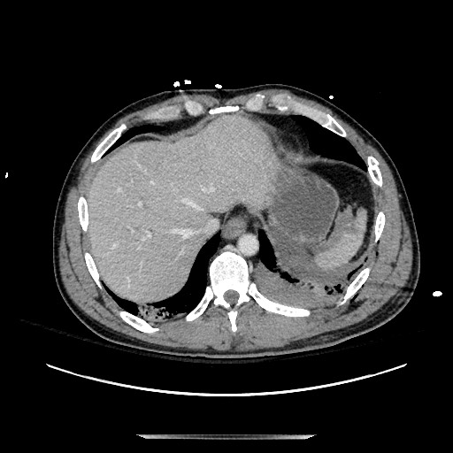 Blunt abdominal trauma with solid organ and musculoskelatal injury with active extravasation (Radiopaedia 68364-77895 A 18).jpg