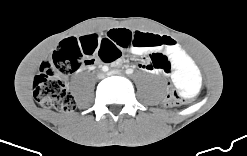 Blunt injury to the small bowel (Radiopaedia 74953-85987 A 115).jpg