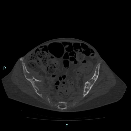 File:Bone metastases from untreated breast cancer (Radiopaedia 42973-46219 Axial bone window 161).jpg
