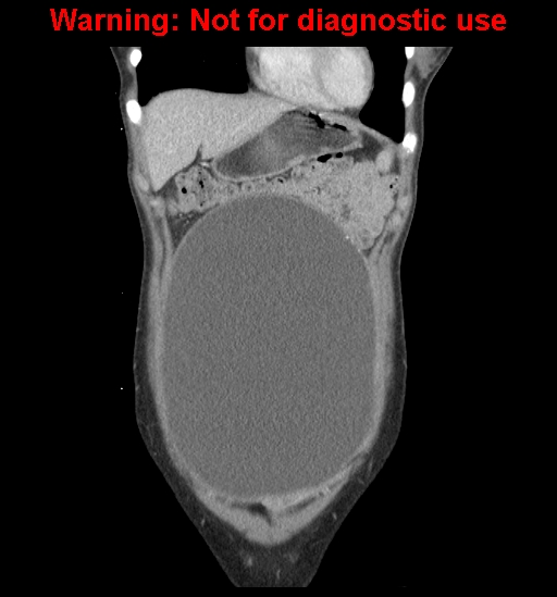 Borderline mucinous cystadenoma of ovary (Radiopaedia 25586-25767 B 11).jpg
