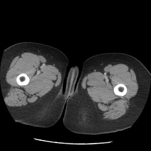 File:Borderline mucinous tumor (ovary) (Radiopaedia 78228-90808 A 151).jpg