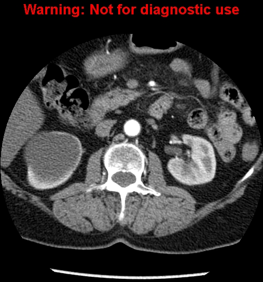 File:Bosniak renal cyst - type II (Radiopaedia 23404-23468 B 23).jpg