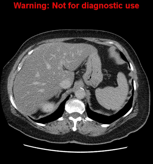 File:Bosniak renal cyst - type II (Radiopaedia 23404-23468 F 13).jpg
