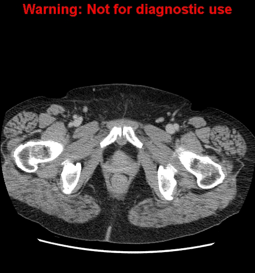 File:Bosniak renal cyst - type II (Radiopaedia 23404-23468 F 69).jpg