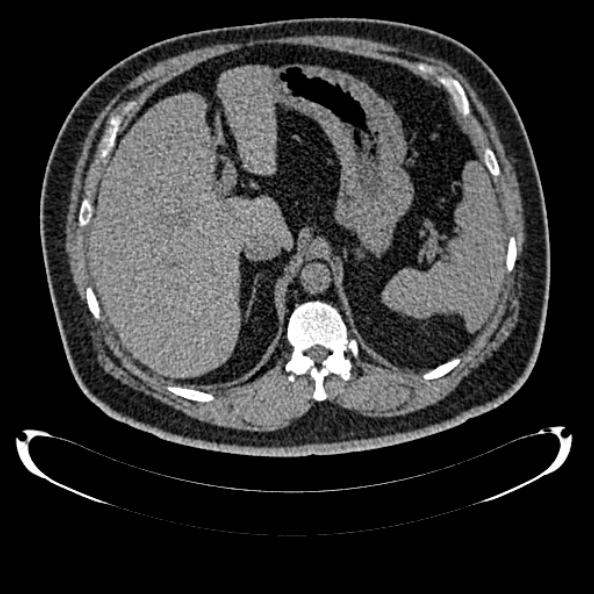 Bosniak renal cyst - type IV (Radiopaedia 24244-24518 Axial non-contrast 101).jpg