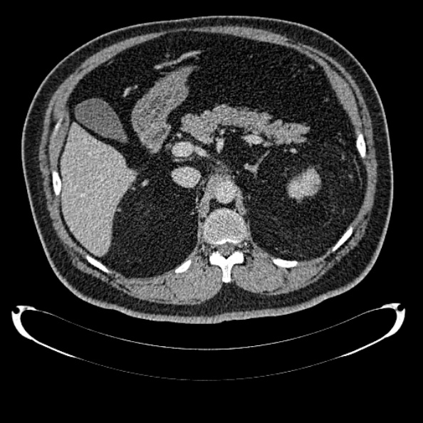 File:Bosniak renal cyst - type IV (Radiopaedia 24244-24518 C 102).jpg