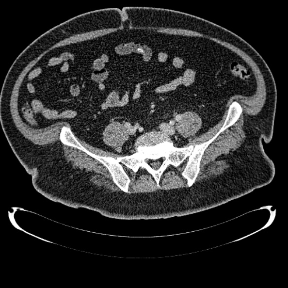 Bosniak renal cyst - type IV (Radiopaedia 24244-24518 C 284).jpg