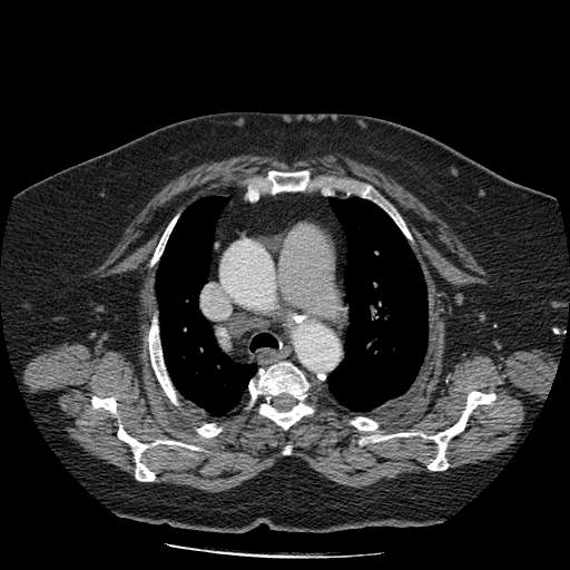 Bovine aortic arch - right internal mammary vein drains into the superior vena cava (Radiopaedia 63296-71875 A 45).jpg