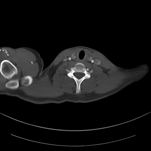 Brachiocephalic trunk pseudoaneurysm (Radiopaedia 70978-81191 Axial bone window 32).jpg