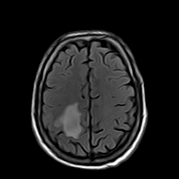File:Brain abscess complicated by intraventricular rupture and ventriculitis (Radiopaedia 82434-96571 Axial FLAIR 18).jpg